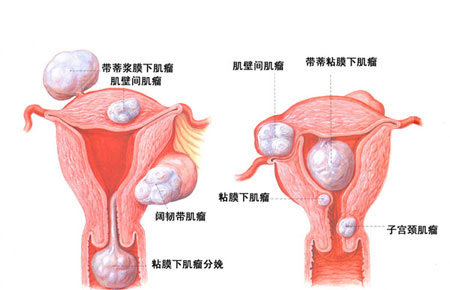 多发性子宫肌瘤的危害有哪些